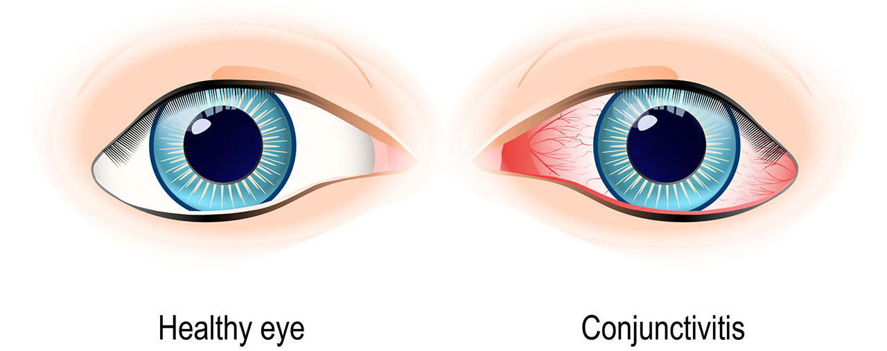 conjunctivitis-kidshealth-nz